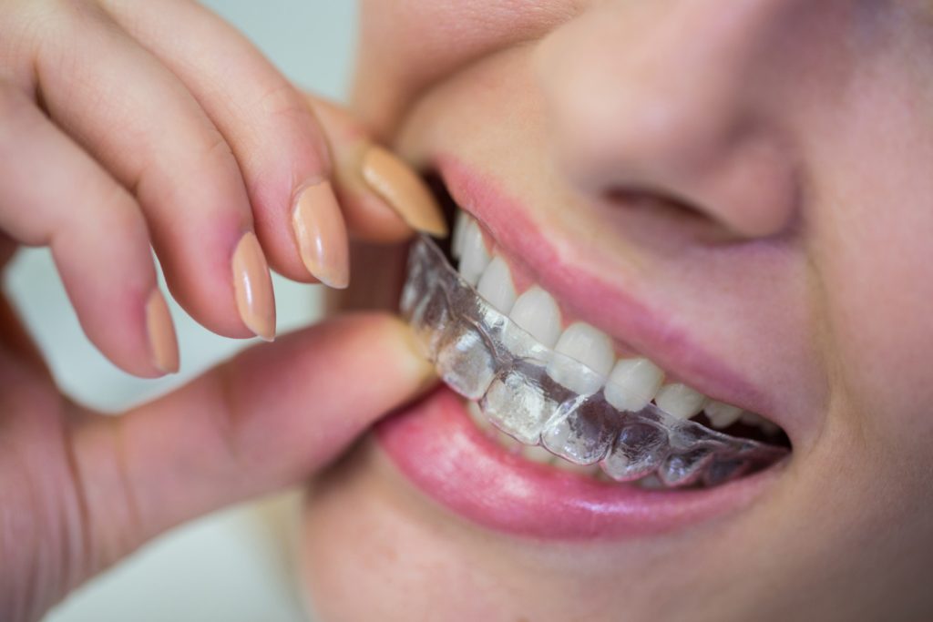 Patiente portant des aligneurs transparents pour corriger l’alignement des dents chez Chadi Dental Clinic à Casablanca.