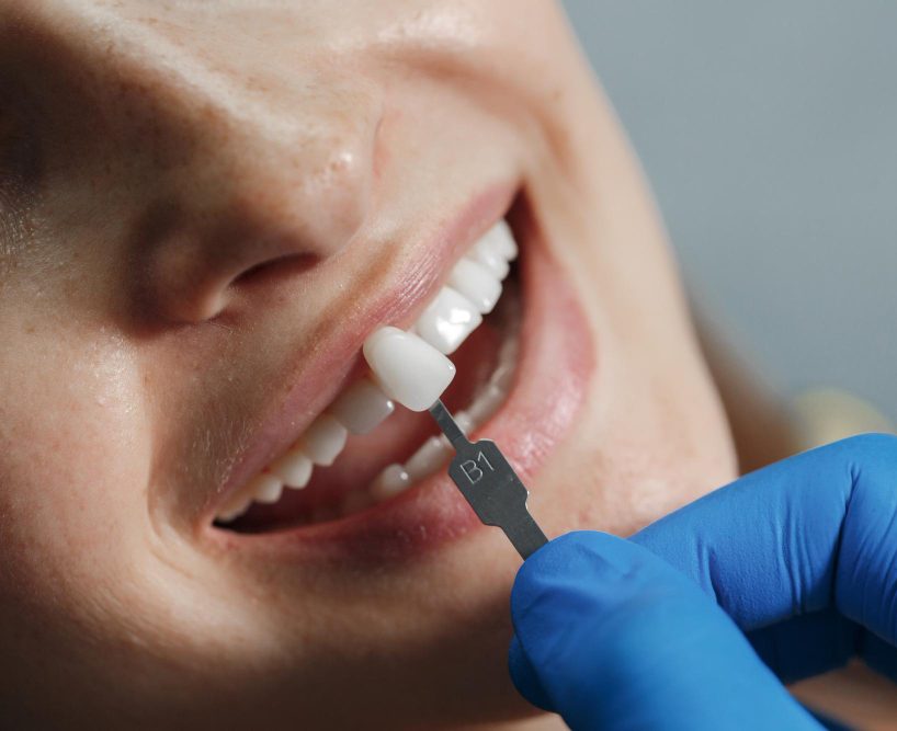 Implant dentaire pour remplacer une dent manquante