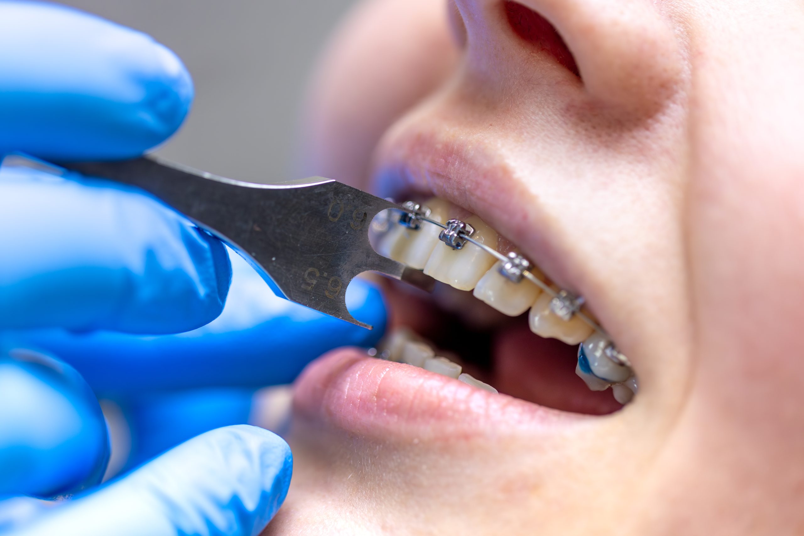 Traitement orthodontique pour aligner les dents et corriger l’occlusion