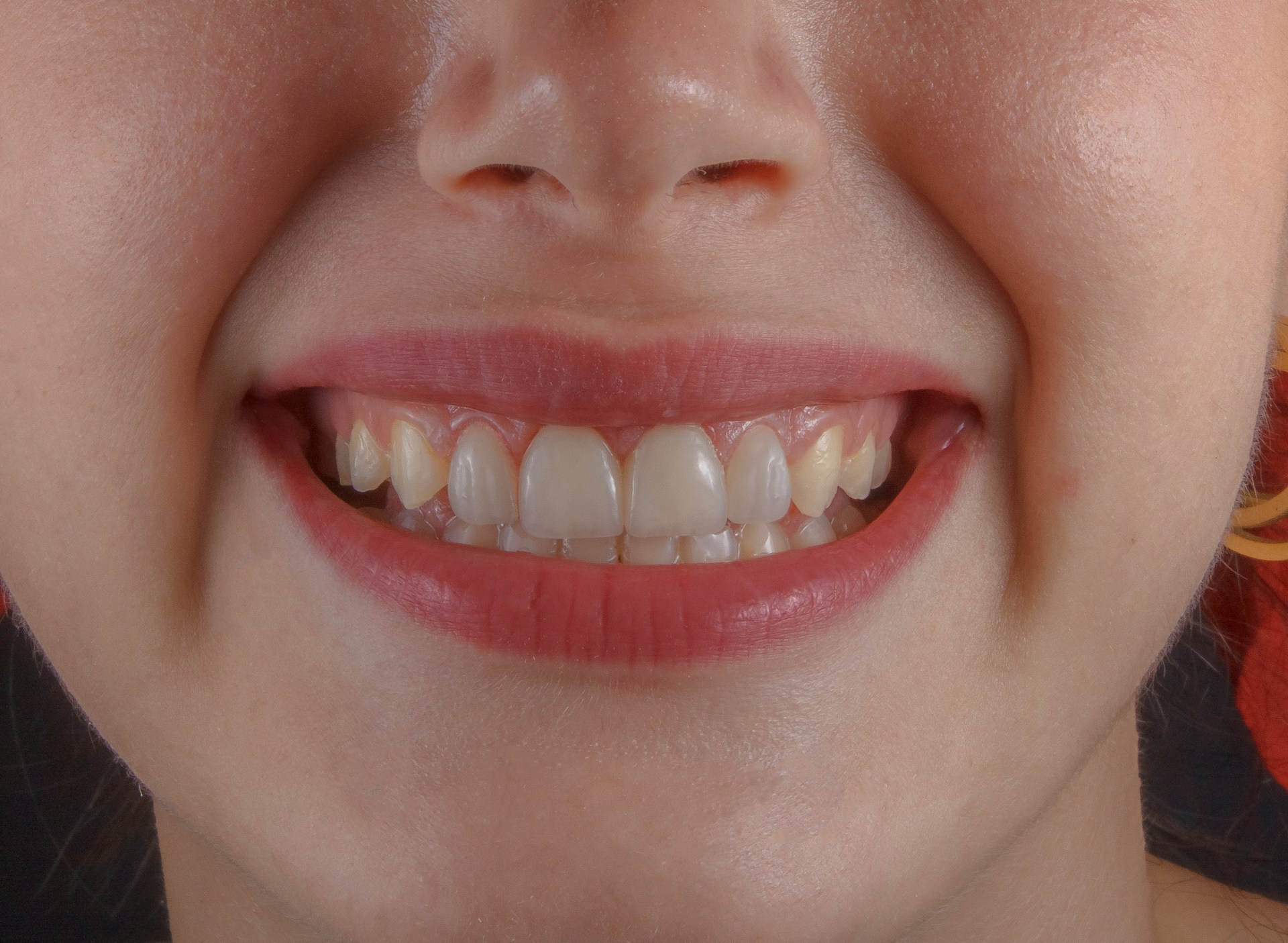 Gros plan d'un sourire mettant en évidence des dents et des gencives saines, illustrant les soins de parodontologie proposés par Chadi Dental Clinic à Casablanca.